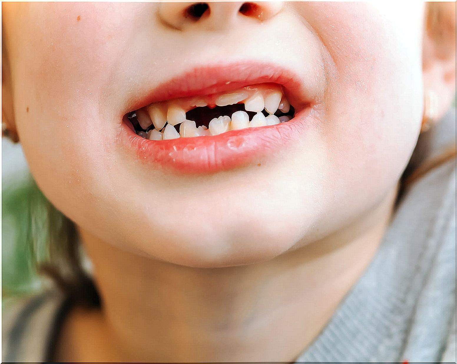 Child showing his milk teeth after a blow.