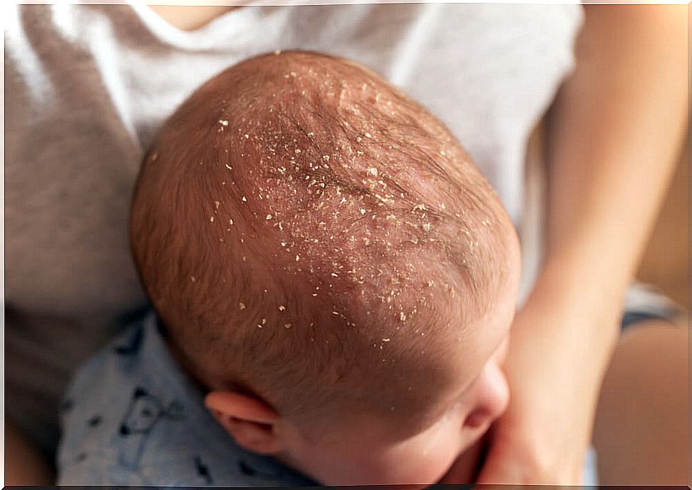 Childhood seborrheic dermatitis.