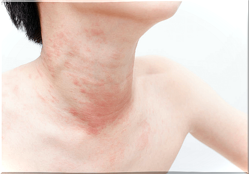 Chronic urticaria in children.