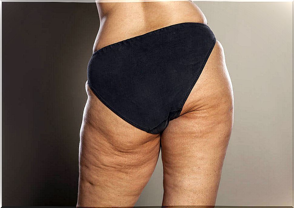 Do you know how to combat aesthetic cellulite?