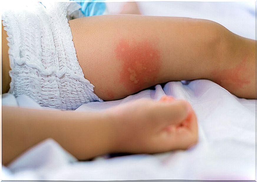 How to treat diaper rash?