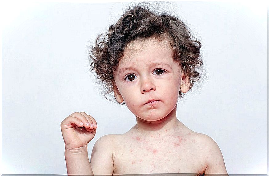 Sweat allergy in children